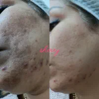 خدمات حرفه ای پاکسازی و فیشال جوانسازی و درمان زخم