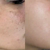 برداشت تخصصی کک ومک ژل بوتاکس جوانسازی