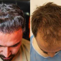 کاشت مو بدون درد و ورم (بدون تراشیدن مو)|خدمات آرایشگری و زیبایی|تهران, صادقیه|دیوار