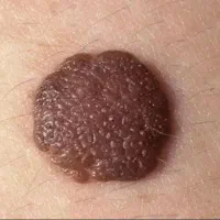 اچ پی ویتو درمان کن