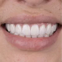 تخفیف کامپوزیت لمینت دندان عصبکشی روکش ایمپلنت|خدمات زیبایی و سلامت|شیراز, قصرالدشت|دیوار