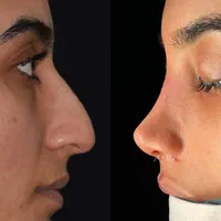 ۵۰ درصد تخفیف عمل جراحی بینی بدون تامپون با پیزو|خدمات آرایشگری و زیبایی|فردیس, طالقانی|دیوار