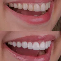 کامپوزیت دندان / آفر ویژه