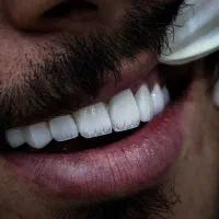 دندانپزشکی اقساطی/ عصب‌کشی/لمینت و کامپوزیت