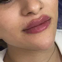 تخفیف ویژه ژل و بوتاکس|خدمات آرایشگری و زیبایی|گنبد کاووس, |دیوار