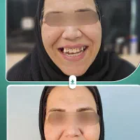 ایمپلنت بلندمدت/کامپوزیت/لمینت/درمانی|خدمات آرایشگری و زیبایی|مرند, |دیوار