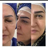 کاشت ابرو، شقیقه، سر، نقدو. اقساط|خدمات زیبایی و سلامت|تهران, فرمانیه|دیوار