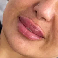 فیلر،بوتاکس،لیزر،فیشال،مزوتراپی