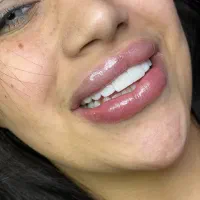 دندانسازی دندانپزشکی کامپوزیت فکی۱۰درمطب ‌ارتودنسی