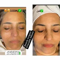 پاکسازی و جوانسازی پوست . هایفو صورت و غبغب|خدمات آرایشگری و زیبایی|مشهد, سجاد شهر|دیوار