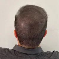 اسکالپ تکنیک نوین پرپشتی مو،جایگزین کاشت مو|خدمات آرایشگری و زیبایی|مشهد, وکیل‌آباد|دیوار