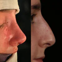 جراحی بینی و پلک، لیفت ابرو و شقیقه، لیفت صورت|خدمات آرایشگری و زیبایی|خوی, |دیوار