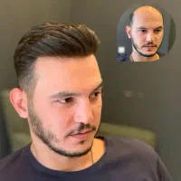 کاشت موی تضمینی با خط رویش 100٪ طبیعی|خدمات آرایشگری و زیبایی|شهرکرد, |دیوار