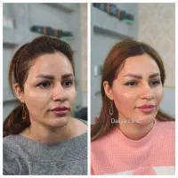 جشنواری تخفیفی کلینیک زیبایی دالیا (فیلر و بوتاکس)|خدمات زیبایی و سلامت|تهران, فدک|دیوار