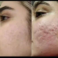 فروش محصولات ضد لک