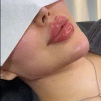 کلینیک پوست و زیبایی ژل لب/فیلرگونه/زاویه/بوتاکس