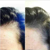 زیبایی.پی ارپی جوانسازی و ژل و بوتاکس.|خدمات آرایشگری و زیبایی|اصفهان, شهرک کاوه|دیوار