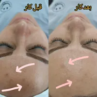 انواع فیشال و پاکسازی پوست در حوزه زیبایی|خدمات آرایشگری و زیبایی|لاهیجان, انقلاب|دیوار