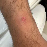 با یک جلسه کک و مکا حذف کن|خدمات آرایشگری و زیبایی|خرم‌آباد, |دیوار