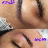 ریموو تخصصی تتو همراه آنزیم تراپی و مزو رویش ابرو