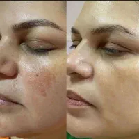 پوستی درخشان و بدون لک ظاهری جوان‌تر