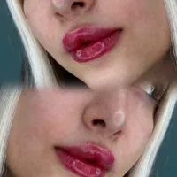 ژل لب فیلر بینی ژل۹۹۰ بوتاکس ۷۸۰ فشیال فیلر بینی