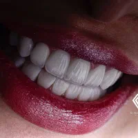 جشنواره دندانپزشکی کامپوزیت به مدت یک هفته|خدمات آرایشگری و زیبایی|شیراز, سینما سعدی|دیوار
