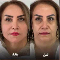 جشنواره لیفت/جوانسازی/انواع هایفو/در1جلسه فقط ۸۹۰ت