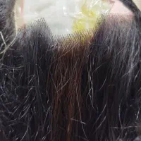 پروتز مو زنانه مردانه