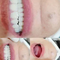 ساخت دندان از دست رفته