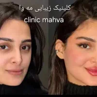 فیلر بوتاکس آنزیم مزوتراپی مزونیدل پلاسما جوانسازی
