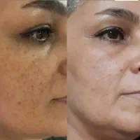 محو کننده تمام لک وچین و چروک با بیوممتیک