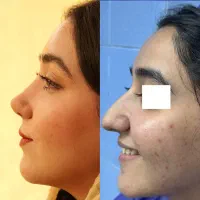 جراحی بینی تخصصی ،باقیمت ویژه،۵۰درصد آف در تهران