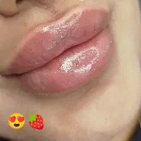 تزریق ژل لب