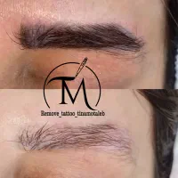 حذف تتو از صورت شما|خدمات آرایشگری و زیبایی|اهواز, کیانپارس |دیوار