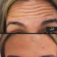 آموزش ژل و بوتاکس با استخدام