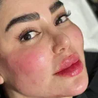 جشنواره ویژه بوتاکس و فیلر بادی و بیکینی و سینه