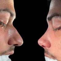 ۵۰ درصد تخفیف عمل جراحی بینی بدون تامپون با پیزو|خدمات آرایشگری و زیبایی|فردیس, طالقانی|دیوار