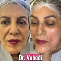 تخفیف ویژه لیفت و جوانسازی صورت