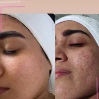 پاکسازی و فیشال پوست