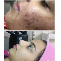 هایفوتراپی و فشیال پوست کره ای|خدمات آرایشگری و زیبایی|یزد, |دیوار