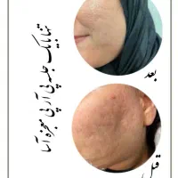 تخفیف فیلر ،بوتاکس، پی ار پی، مزو،لیزر توسط پزشک