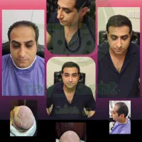 کاشت مو با ضمانت نامه