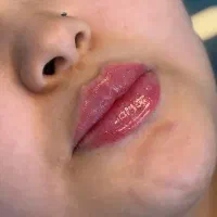 تزریق ژل و بوتاکس صورت و کانیتورینگ