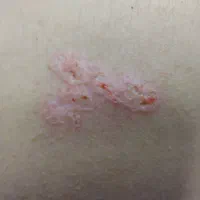 مرکز تخصصی خال و زگیل ذگیل تناسلی لیزر،کرایو|خدمات آرایشگری و زیبایی|تهران, جمهوری|دیوار