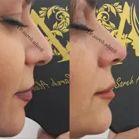 اصلاح فرم و کوچک کردن بینی توسط پزشک بدون جراحی|خدمات آرایشگری و زیبایی|قم, دورشهر|دیوار
