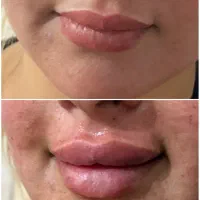 تزریق ژل وبوتاکس برای مدل|خدمات آرایشگری و زیبایی|اهواز, پردیس دو|دیوار