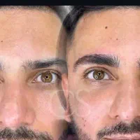 میکروبلیدینگ و ریموو حرفه‌ای|خدمات آرایشگری و زیبایی|اهواز, زیتون کارمندی|دیوار