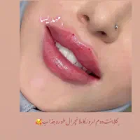 تزریق فیلر و‌بوتاکس با۹سال سابقه کاری