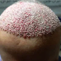 کاشت مو پرتراکم ‌‌‌‌تزریق ژل و فیلر لب گونه فک